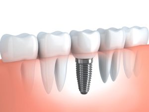 Dental Implants - Dental Loomis
